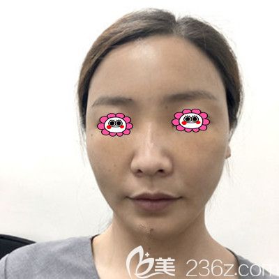 全臉脂肪填充第5天照片