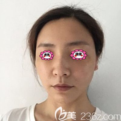 脂肪填充30天恢復(fù)照片