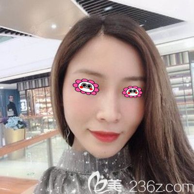 衡陽美萊為體重偏瘦的我做面部脂肪填充，效果令我很滿意