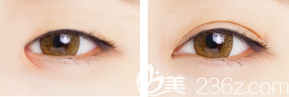 韓國仁川佳顏孫基學(xué)韓式無痕雙眼皮案例效果對比圖 韓國仁川佳顏孫基學(xué)韓式無痕雙眼皮案例效果對比圖