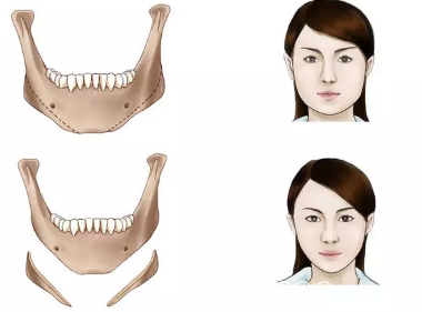 傳統(tǒng)下頜角切除示意圖
