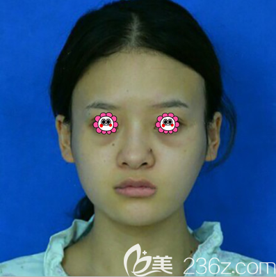 在北京紫潔醫(yī)美做自體脂肪面部填充前樣子 在北京紫潔醫(yī)美做自體脂肪面部填充前樣子