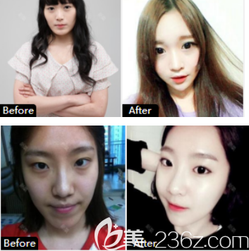 下頜角切除案例