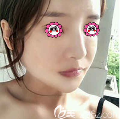 王春燕醫(yī)生給我做完自體脂肪面部填充第5天效果 王春燕醫(yī)生給我做完自體脂肪面部填充第5天效果