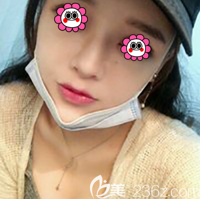 在北京紫潔做完自體脂肪面部填充第11天效果 在北京紫潔做完自體脂肪面部填充第11天效果