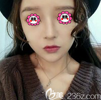 北京紫潔儷方醫(yī)療美容自體脂肪面部填充案例 北京紫潔儷方醫(yī)療美容自體脂肪面部填充案例