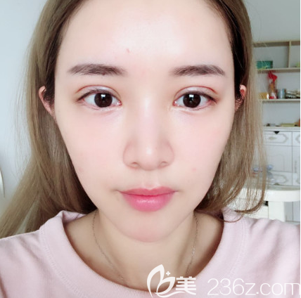 全切雙眼皮術(shù)后八天恢復(fù)效果圖 全切雙眼皮術(shù)后八天恢復(fù)效果圖