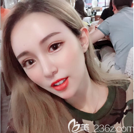 深圳美萊割雙眼皮術(shù)后一個月效果圖 深圳美萊割雙眼皮術(shù)后一個月效果圖