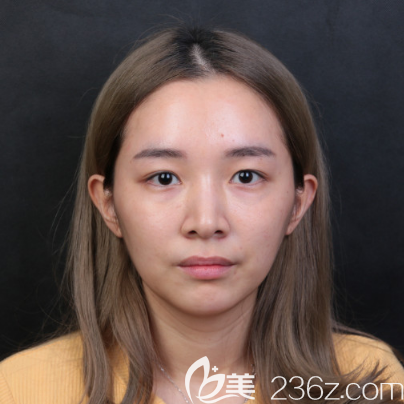 術(shù)前單眼皮照片 術(shù)前單眼皮照片