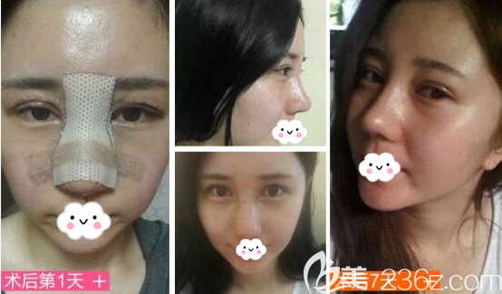 南充華美名媛雙眼皮隆鼻術(shù)后效果展示