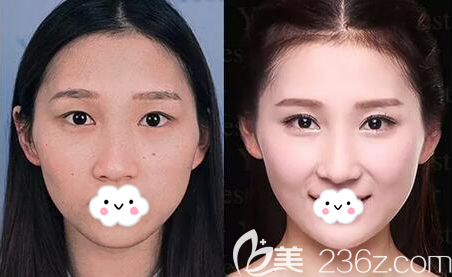 南充阿藍(lán)沙新力雙眼皮術(shù)前術(shù)后對(duì)比效果