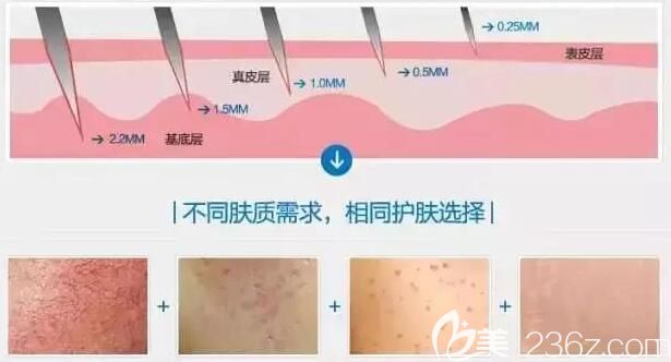 無(wú)錫施爾美分享微針美膚原理