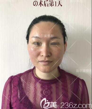 剛做完微針美膚天面部泛紅