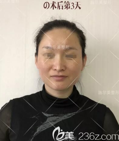 做完微針美膚術(shù)后三天恢復(fù)