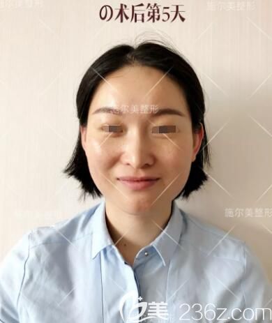 術(shù)后五天微針美膚效果展示