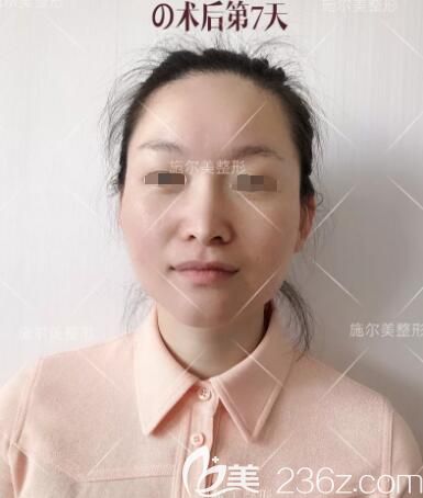 孫華醫(yī)生分享術(shù)后一周微針美膚分享