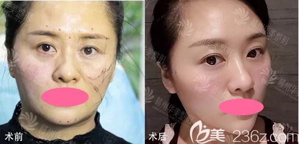 贛州華美整形牛先翠面部線雕案例效果圖