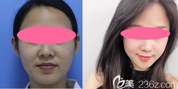 贛州華美牛先翠注射瘦臉真人案例前后對比圖