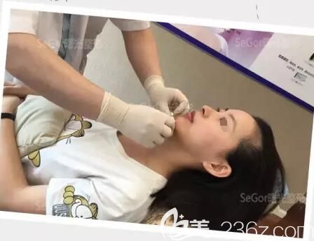 注射喬雅登玻尿酸豐下巴過程中