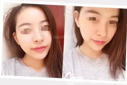 擔(dān)心假體隆下巴創(chuàng)傷大術(shù)后恢復(fù)慢就面診常州曙光醫(yī)生注射玻尿酸豐下巴，2支喬雅登價(jià)格貴但術(shù)后效果自然