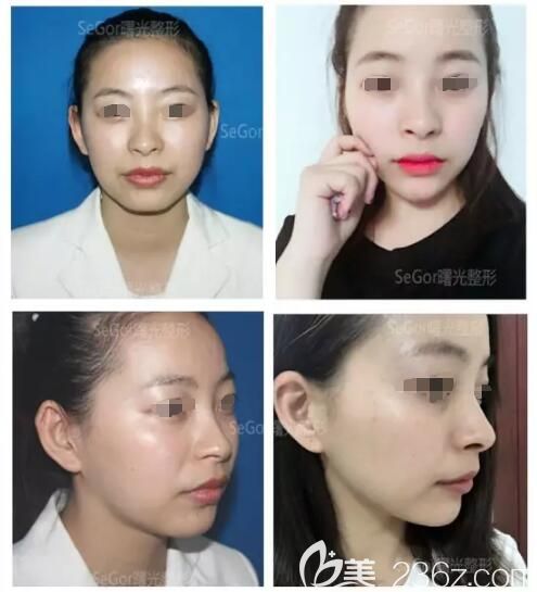 到常州曙光玻尿酸豐下巴術(shù)前術(shù)后對比案例