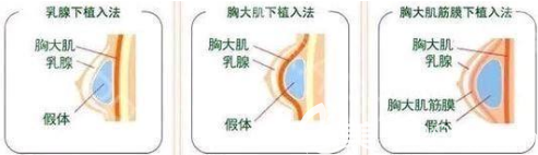 假體豐胸的切口和取出的切口一樣