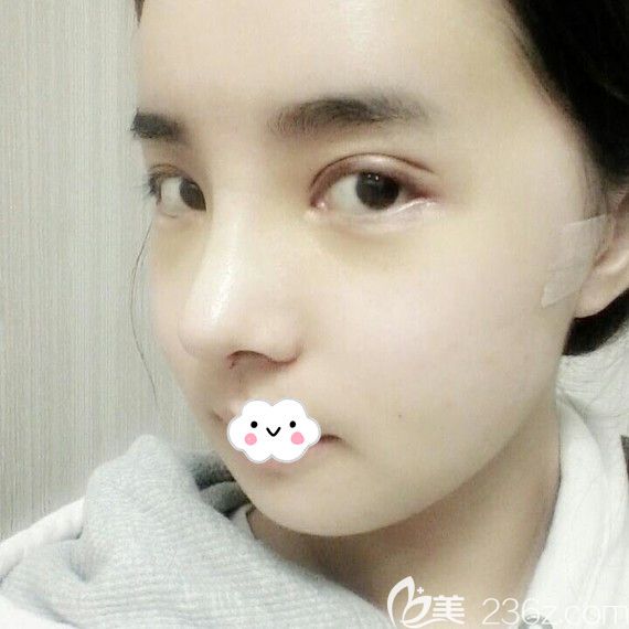 韓國原辰鼻綜合+自體脂肪面部填充術(shù)后效果