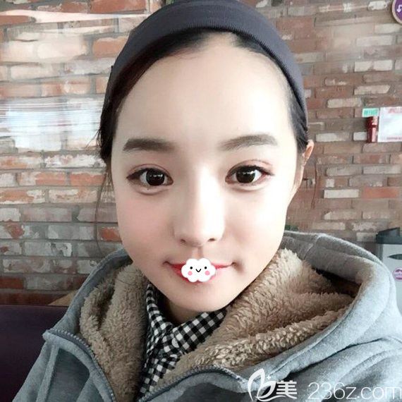 韓國原辰鼻綜合+自體脂肪豐面術(shù)后20天真實恢復(fù)圖