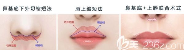 韓國AD愛慕三大隱形無痕人中縮短術(shù)