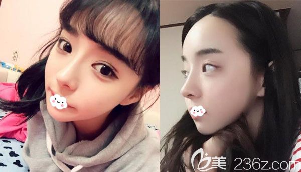 韓國原辰鼻綜合隆鼻+自體脂肪豐面半年恢復(fù)效果圖