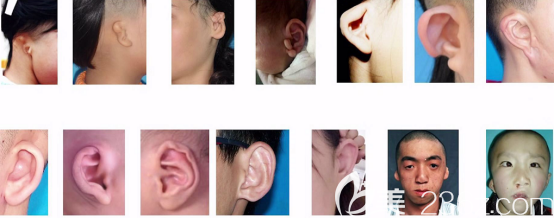 耳朵的畸形所有樣子 耳朵的畸形所有樣子