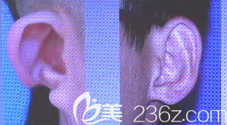 耳朵輕度缺陷案例 耳朵輕度缺陷案例