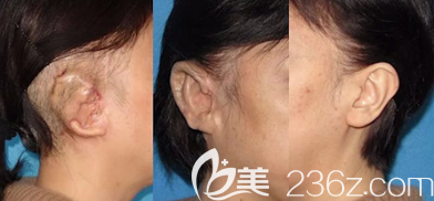 耳朵修復(fù)多次案例 耳朵修復(fù)多次案例