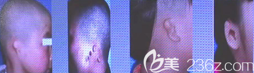 無耳案例 無耳案例