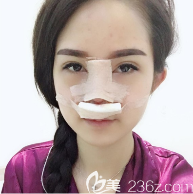 在東莞華美做完鼻子第二天 在東莞華美做完鼻子第二天