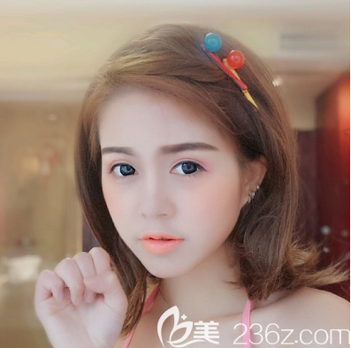 東莞華美鼻綜合隆鼻7天拆線效果圖 東莞華美鼻綜合隆鼻7天拆線效果圖