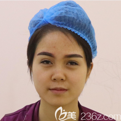 隆鼻術前照片 隆鼻術前照片