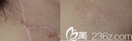 瘢痕治療案例一