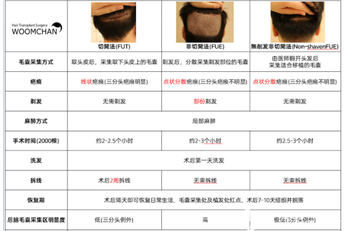 【韓國永長植發(fā)醫(yī)院】切開法(FUT) & 非切開法 (FUE) & 無削發(fā)非切開法 (Non-shavenFUE) 【韓國永長植發(fā)醫(yī)院】切開法(FUT) & 非切開法 (FUE) & 無削發(fā)非切開法 (Non-shavenFUE)
