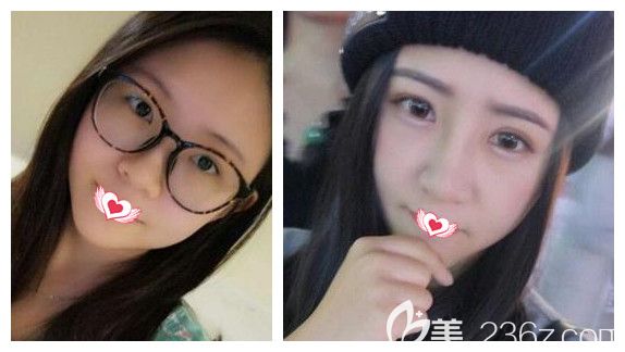 楊鵬主任雙眼皮手術(shù)案例 楊鵬主任雙眼皮手術(shù)案例