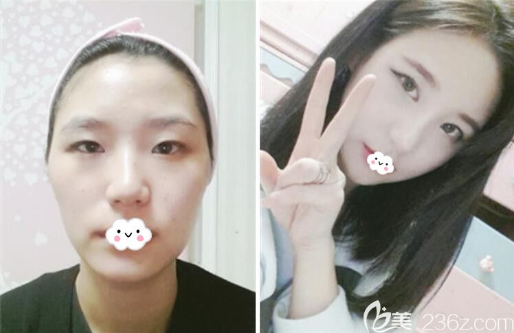 韓國樂得千成俊面部輪廓+韓式無痕雙眼皮+假體隆鼻案例效果對比圖 