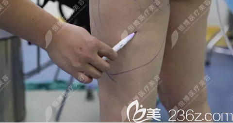 李烈自體脂肪豐臀術(shù)前設(shè)計(jì) 李烈自體脂肪豐臀術(shù)前設(shè)計(jì)