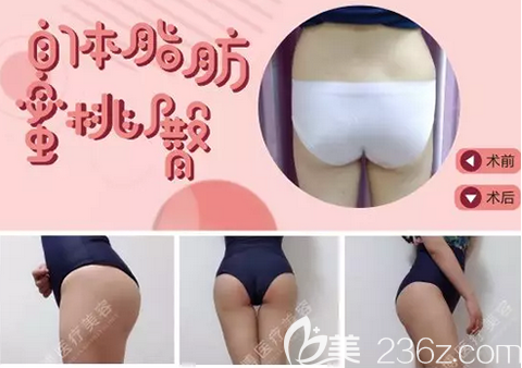 李烈自體脂肪豐臀術(shù)前術(shù)后對(duì)比效果 李烈自體脂肪豐臀術(shù)前術(shù)后對(duì)比效果