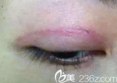 割雙眼皮后產(chǎn)生疤痕的原因