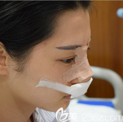 肋軟骨隆鼻術(shù)后四天效果圖