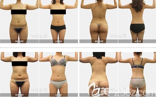 WIZ&美吸脂前后對(duì)比案例