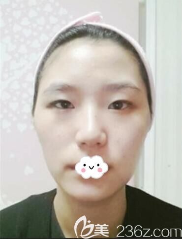 韓國樂得red整形外科做韓式無痕雙眼皮+隆鼻+面部輪廓整形真人案例 韓國樂得red整形外科做韓式無痕雙眼皮+隆鼻+面部輪廓整形真人案例