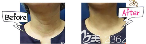 注射消除頸紋的案例