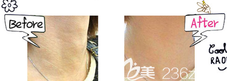 埋線去除頸紋案例