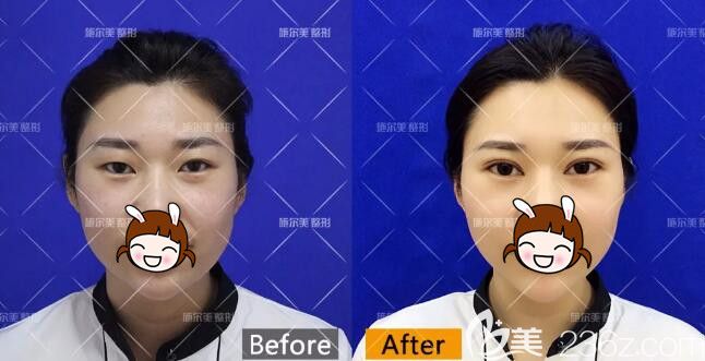 一單一雙在常州施爾美做雙眼皮前后蛻變